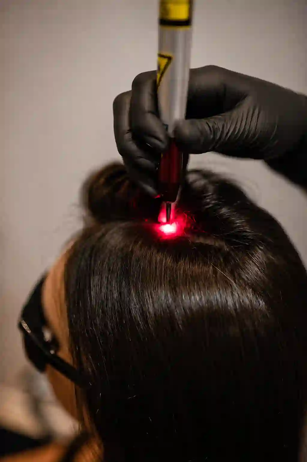 Laser capilar — Dra. Glauce Gonçalves