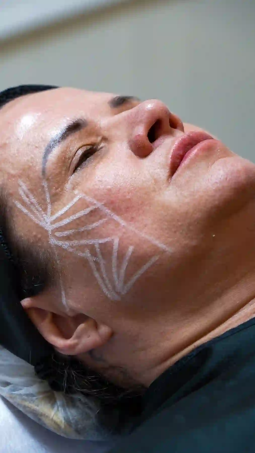 Bioestimulador de colágeno — Dra. Glauce Gonçalves