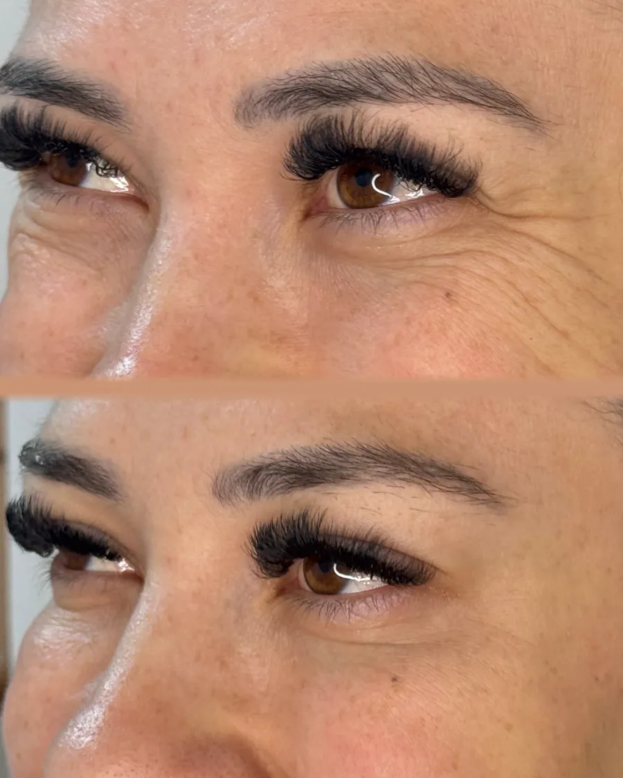 Preenchimento facial com ácido hialurônico — Dra. Glauce Gonçalves